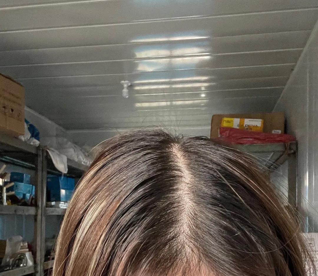 为什么我每天掉头发但还是没秃,总是掉头发快秃了怎么办