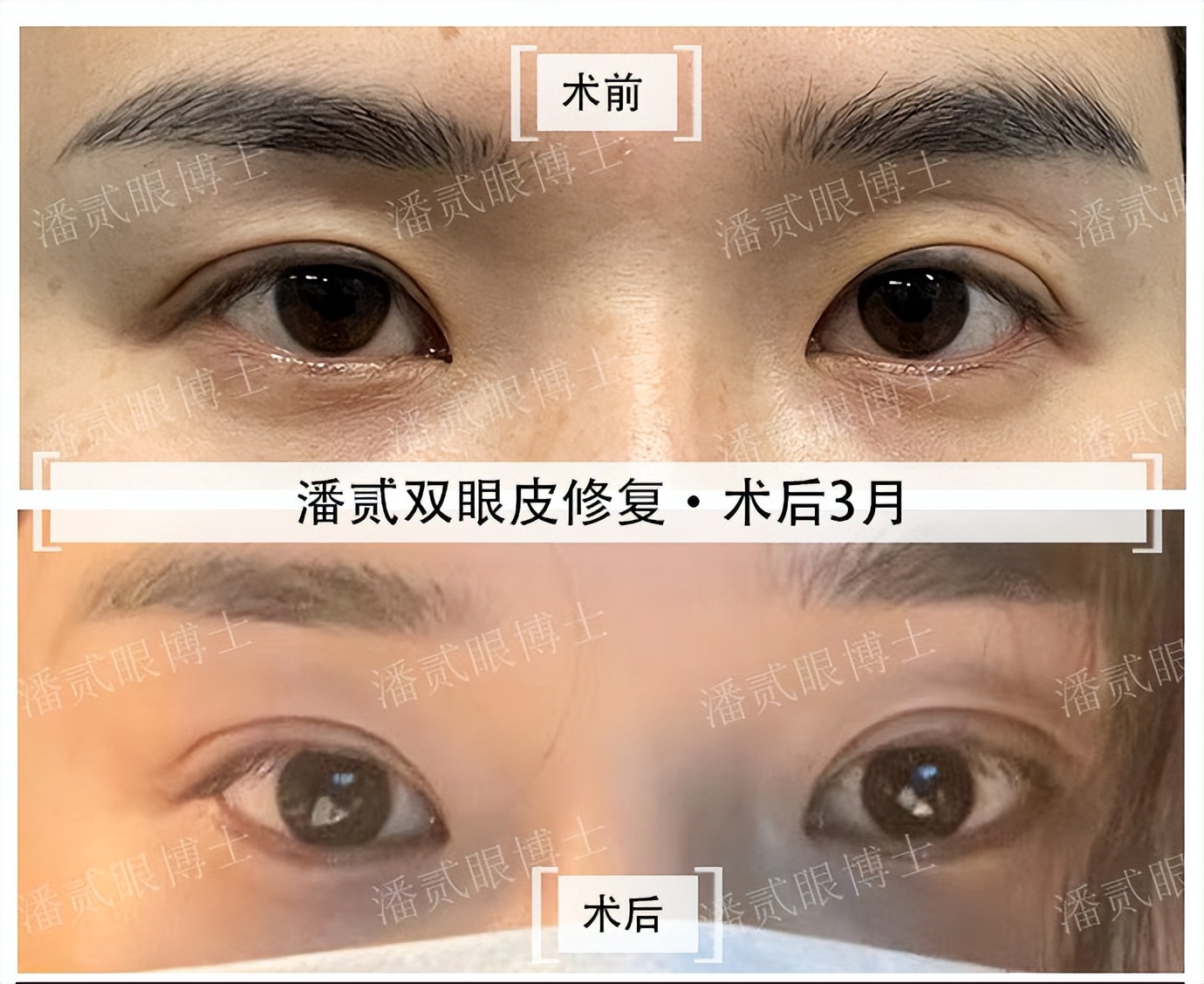 割双眼皮就割一只眼,割双眼皮提肌有风险吗