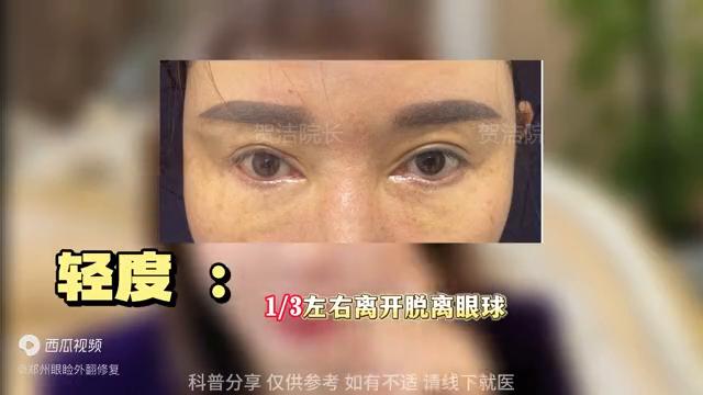 下眼睑外翻修复前后图片,下眼睑外翻是什么样子