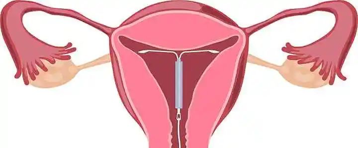 什么是人工流产成功率高,人工流产后怎么避孕最好