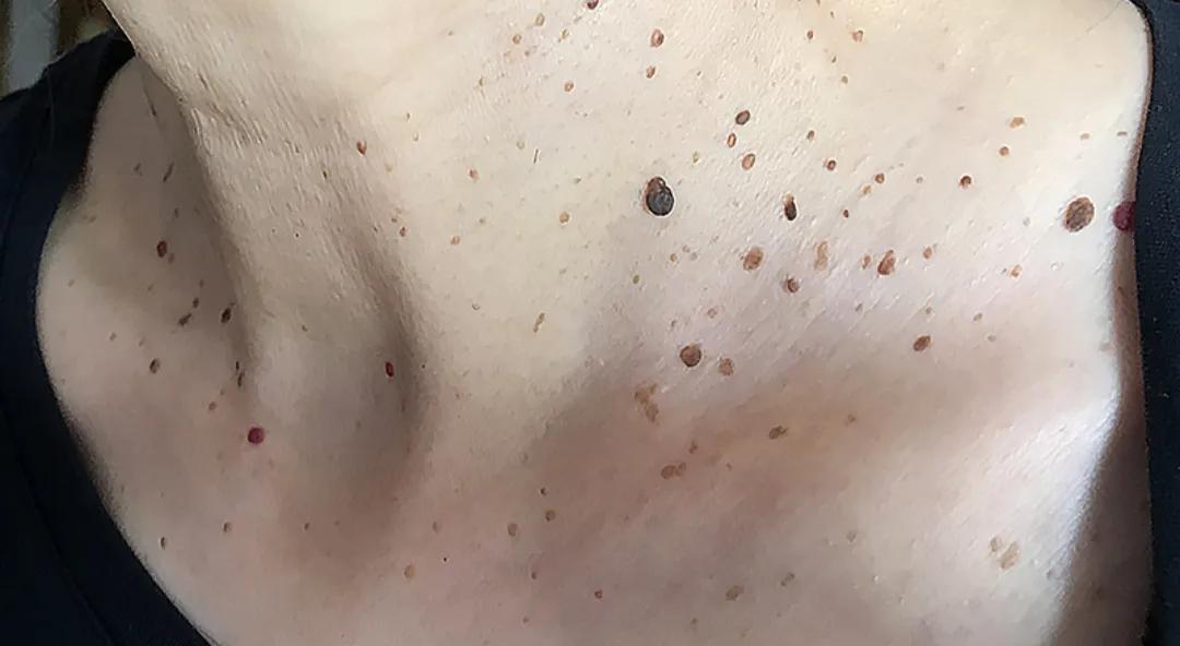 皮肤科董医生门诊分享,皮肤科专家董医生