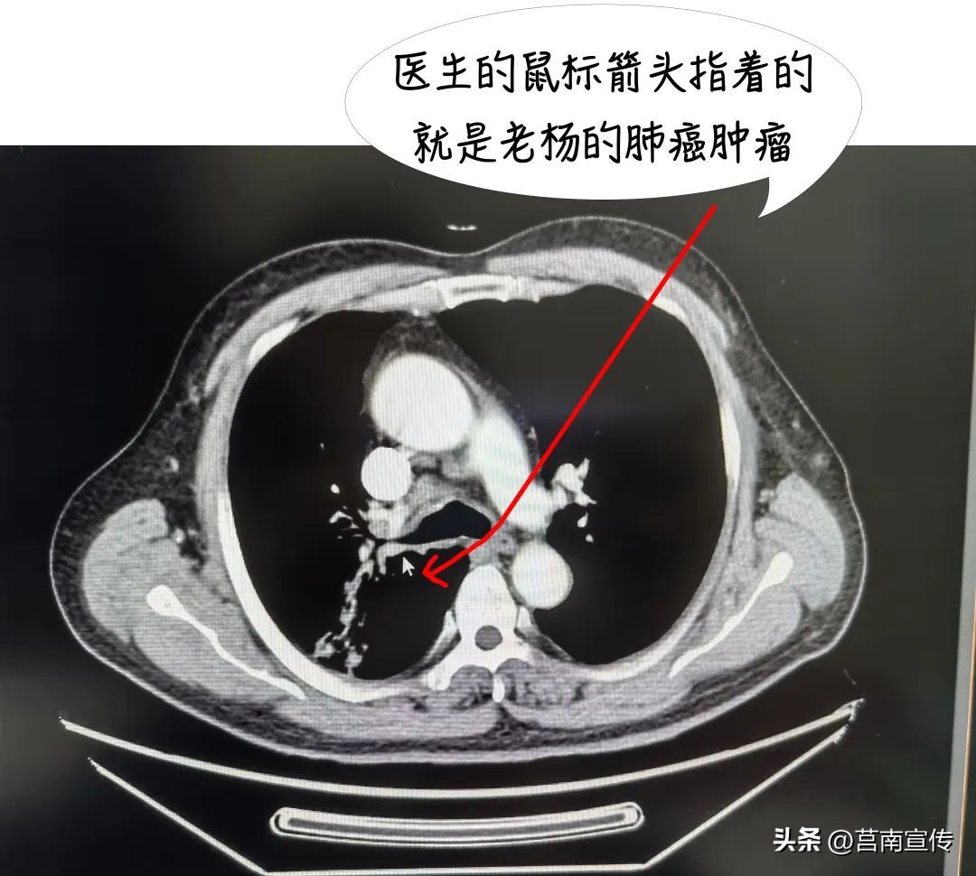 肺癌早期做射波刀,咳嗽有痰做体检查出肺癌严重不