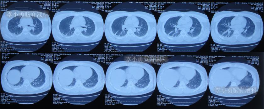 脑积水三脑室造瘘多久能恢复,脑囊虫手术后脑积水