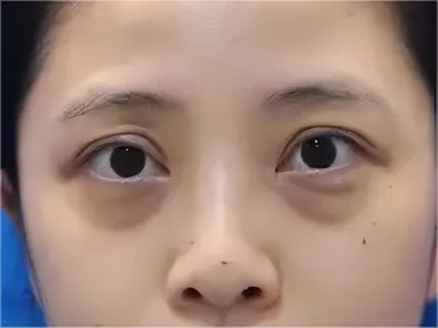 40岁女性眼睛衰老要怎样改善,40岁眼睛衰老怎么办