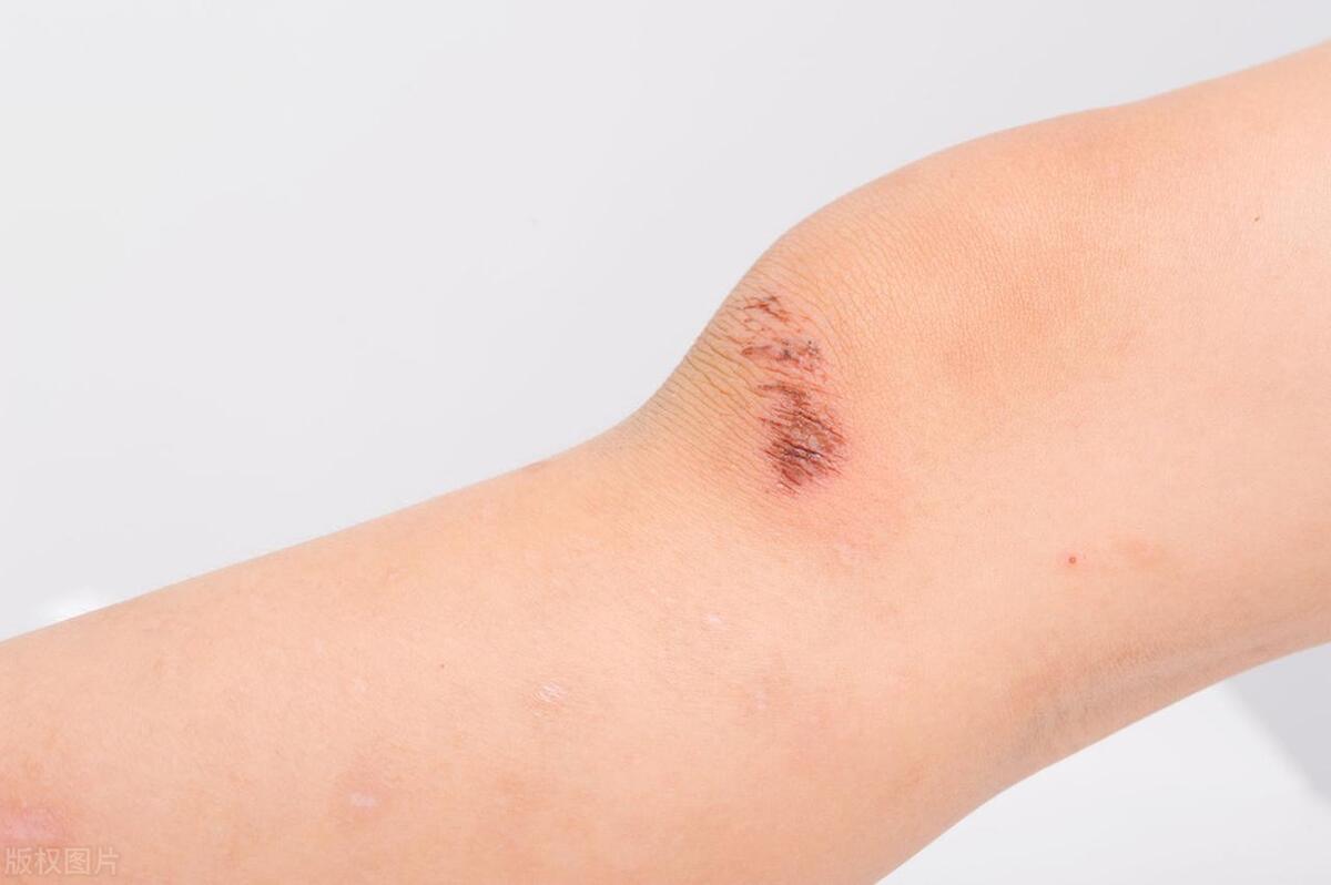 创伤后周围皮肤干燥、疤痕瘙痒难耐?原来是这些原因在作祟!