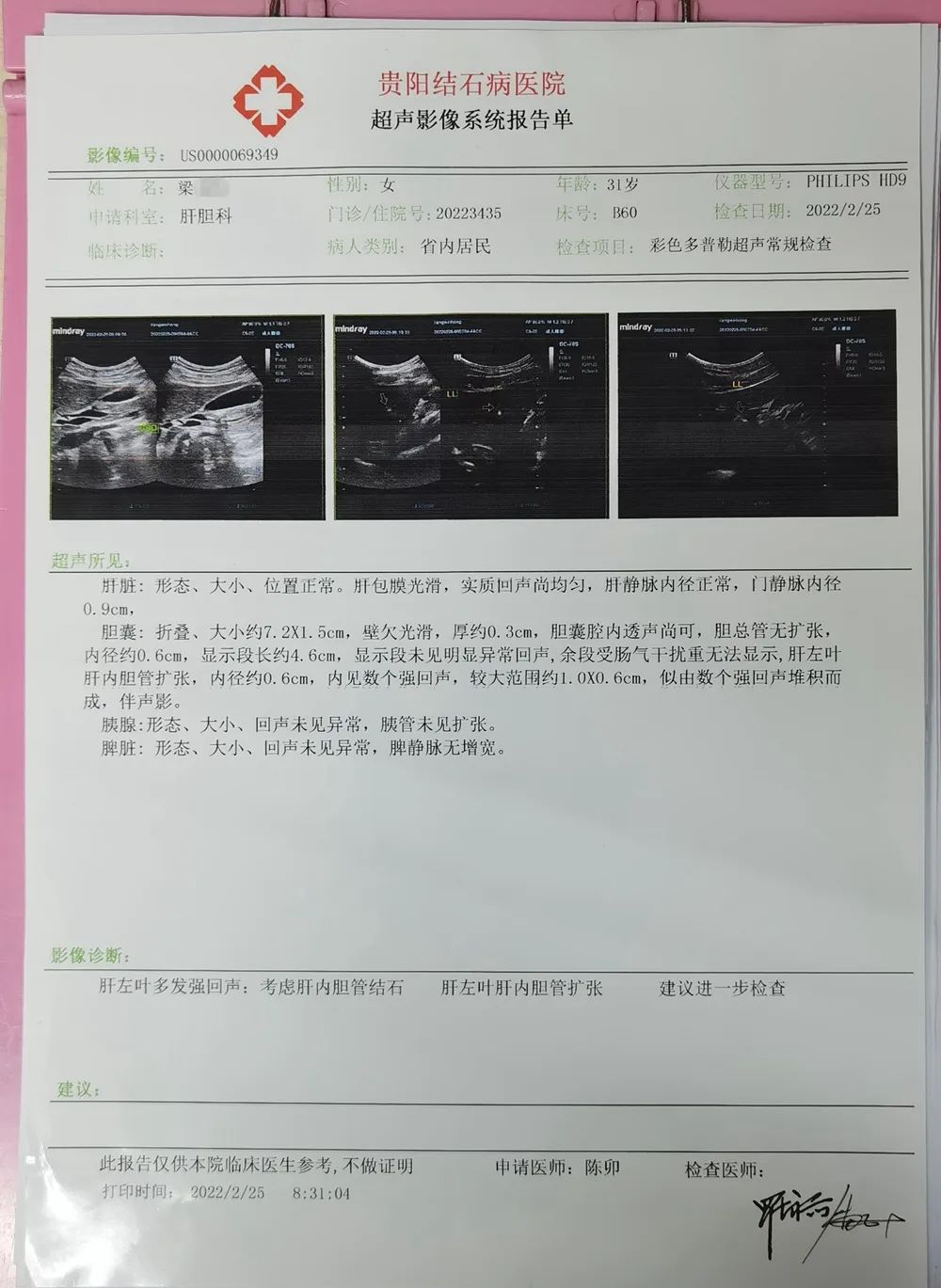 胆结石微创保胆手术大概多少钱,胆囊炎合并胆结石能保胆取石吗