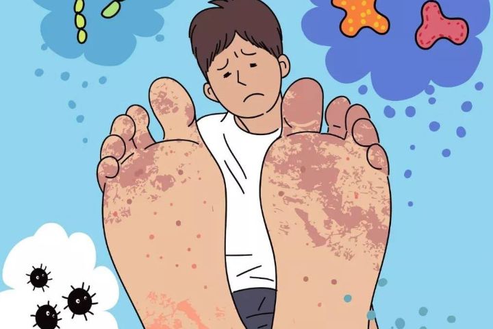 脚气好痒怎么办,脚气太痒怎么办教你一招