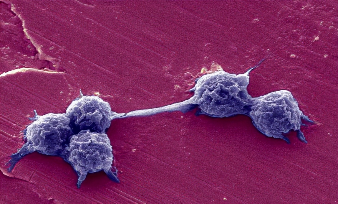 有个小囊肿要注意什么,医生诊断囊肿就一定是囊肿吗