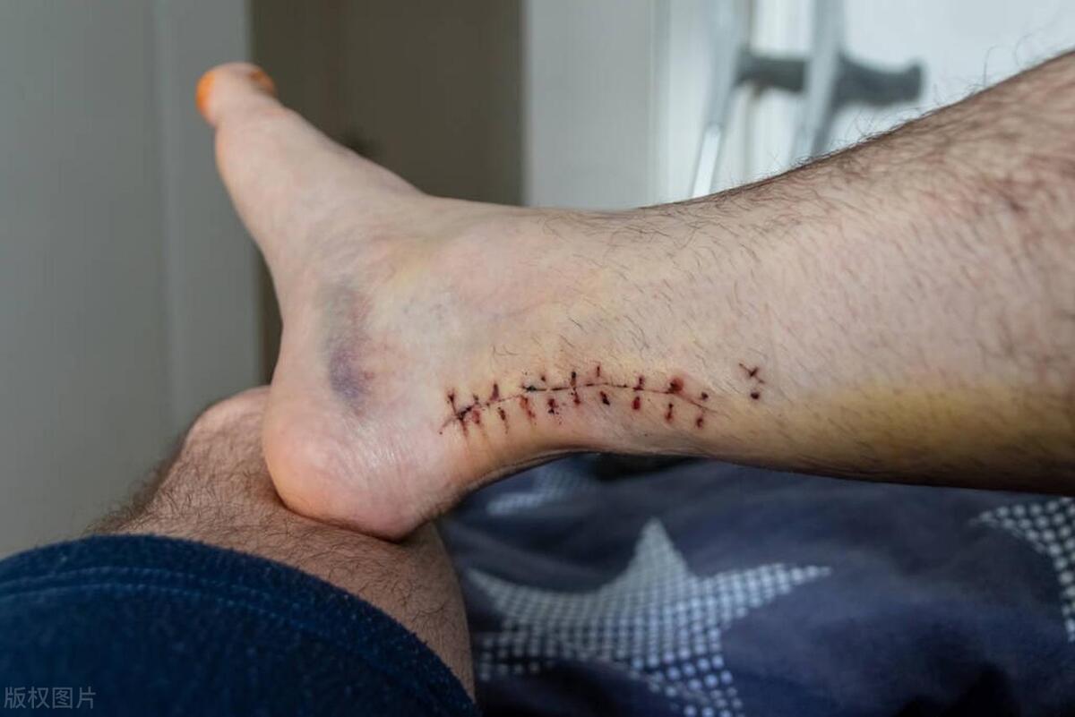 运动员跟腱断裂能恢复到100%吗,足球运动员跟腱断裂影响大吗