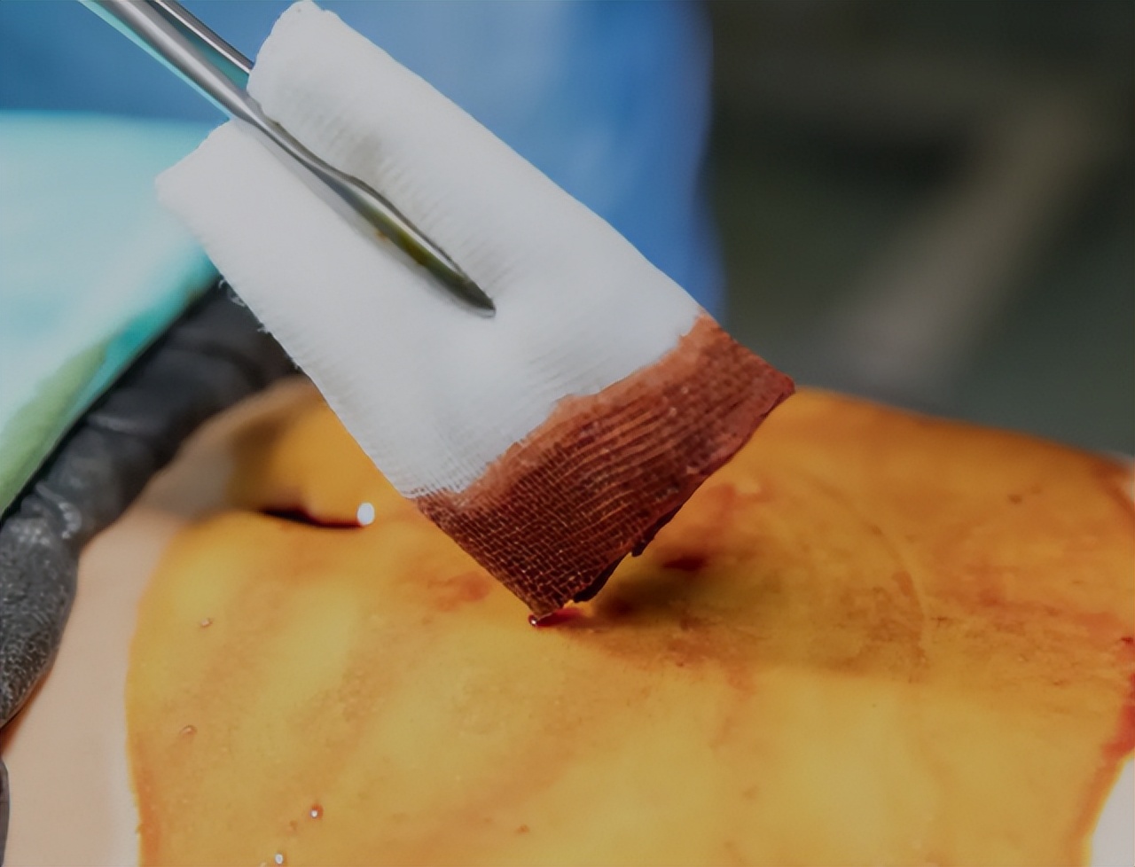 这4种手术方法要谨记,所有手术种类的全过程