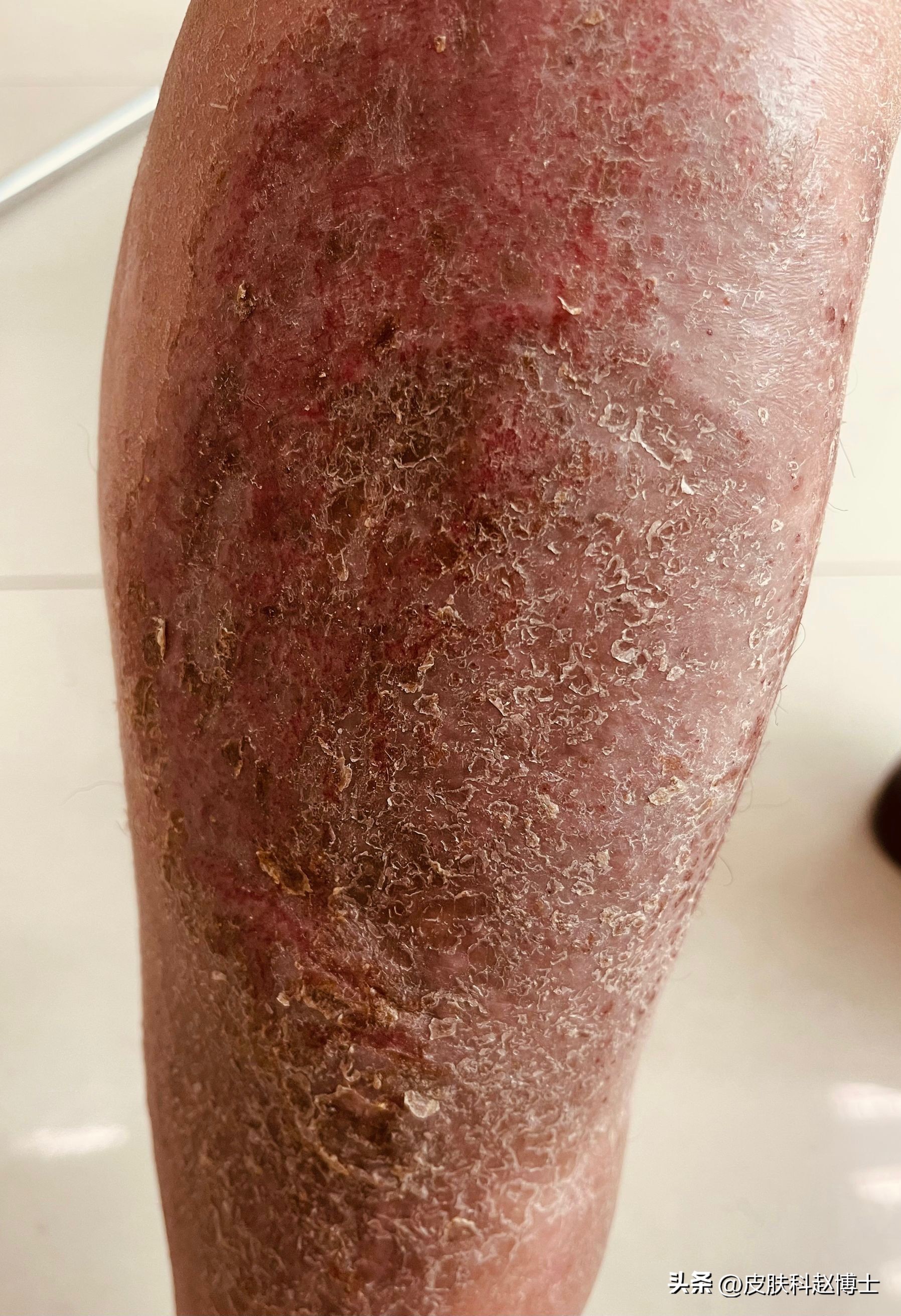 老年人湿疹能洗澡吗,老年人湿疹患处破皮