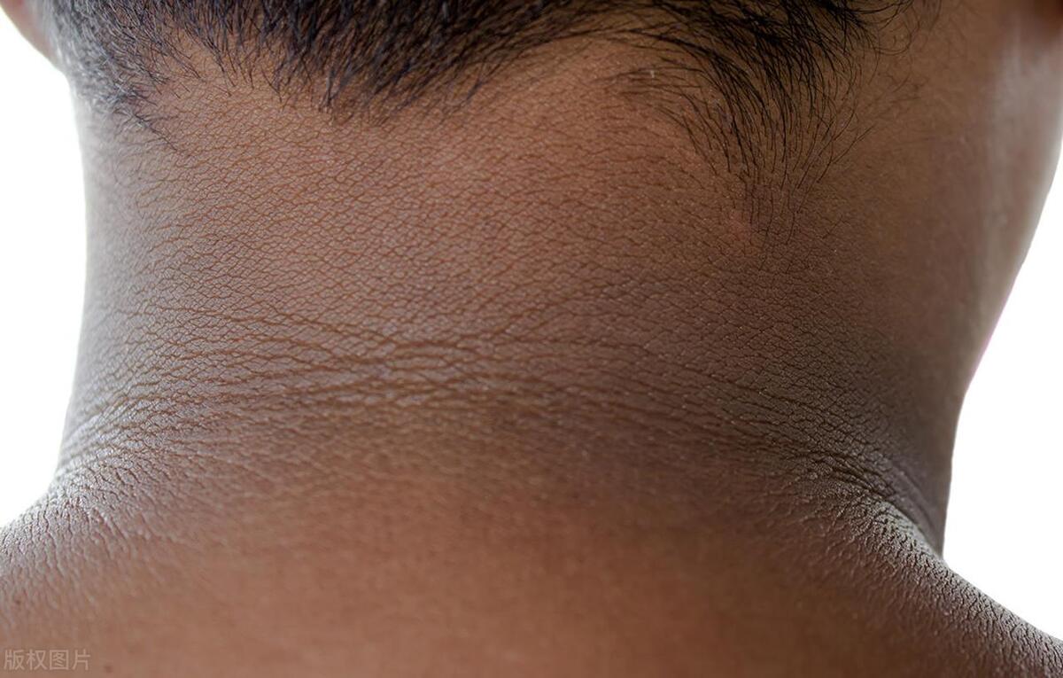 为什么肺癌一期突然变四期,为啥肺癌一发现就是晚期了