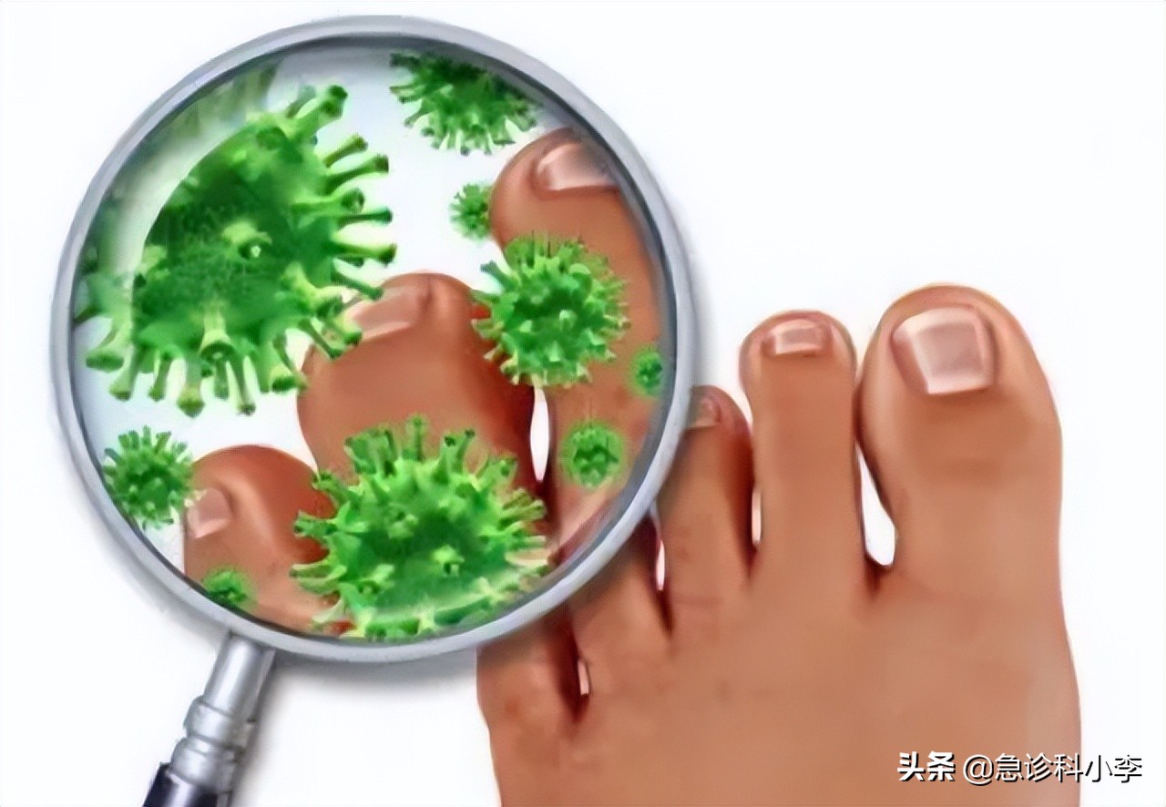 脚气反反复复怎么办？医生：教你2个实用方法，根治脚气不复发