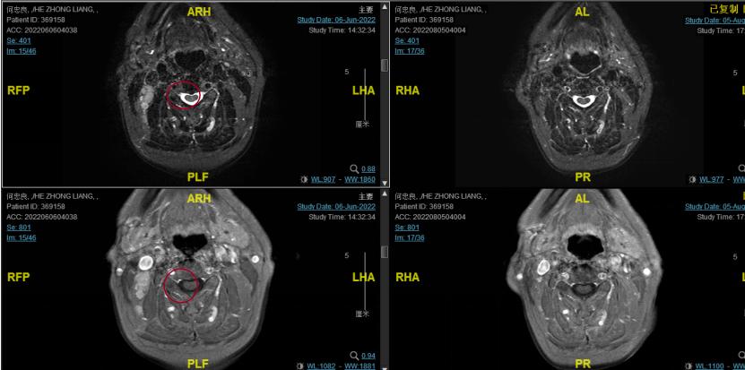 一例Ⅲ期鼻咽癌患者接受同步放化疗联合斯鲁利单抗治疗的经验分享