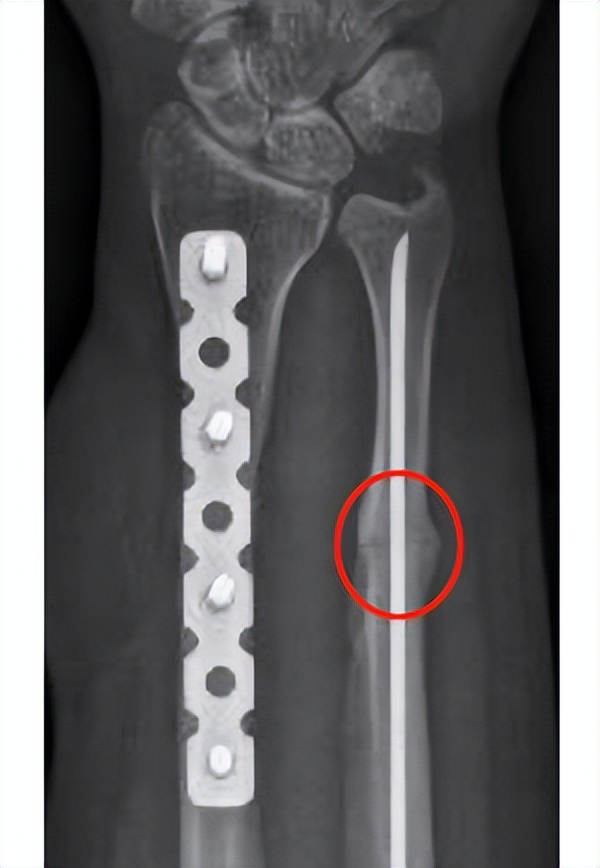 治疗骨折新技术,微创手术治疗骨折的方法