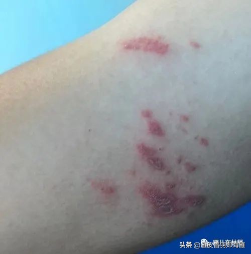 九月初预警：隐翅虫年度盛典，奇怪皮炎频现，教您如何躲着点