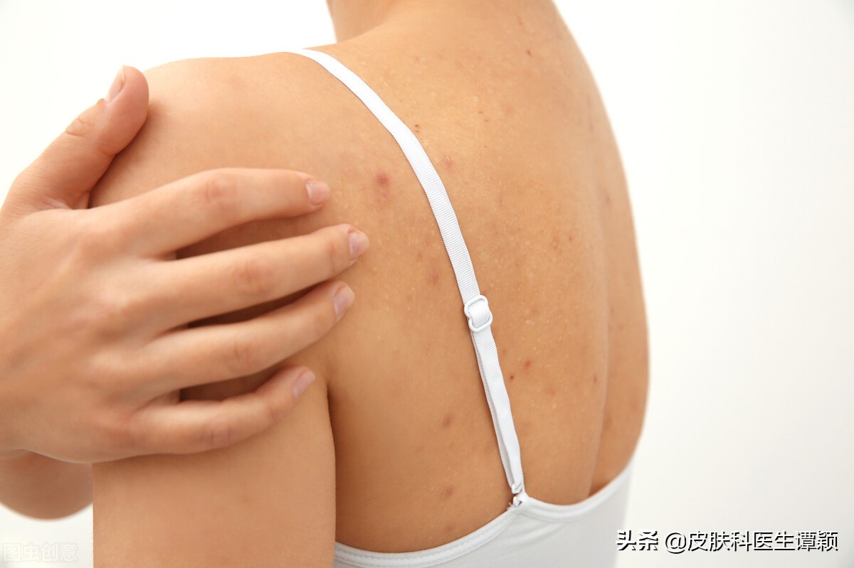 皮肤科医生怎么样确诊疥疮,皮肤科医生谈预防蚊虫