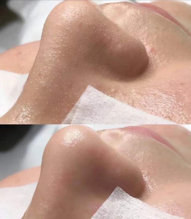 真黑头怎么去,黑头用黑头膏为什么去不掉黑头