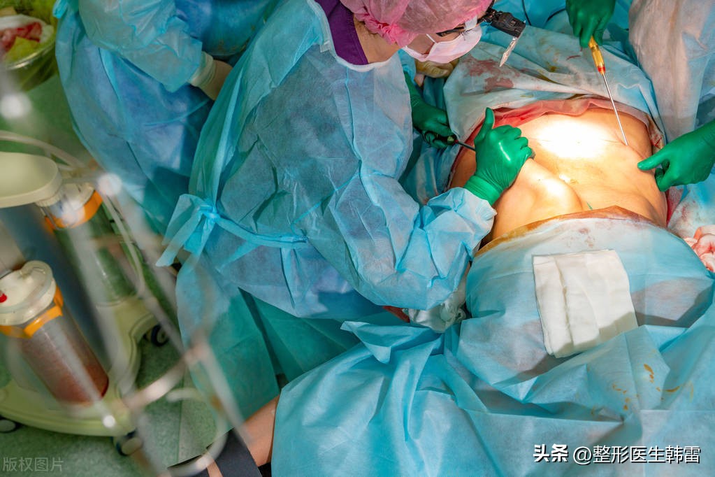 抽脂怎么选择整形医院,抽脂手术是如何进行的