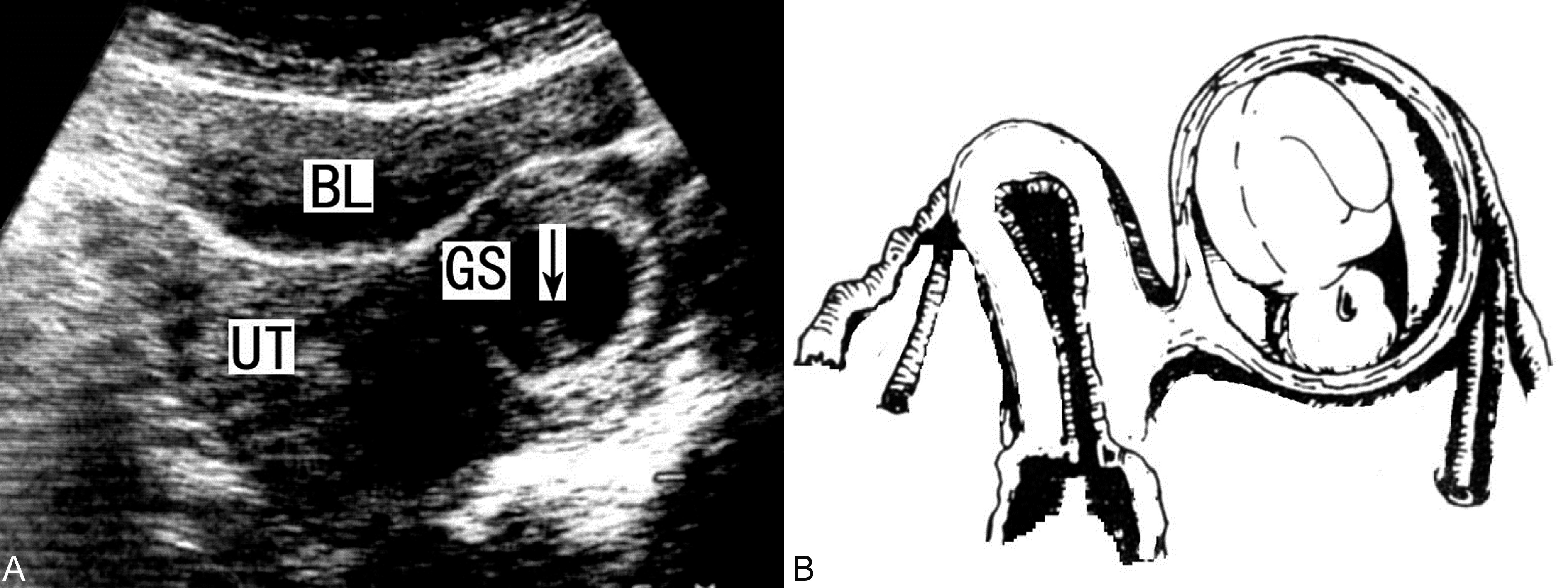 明明白白做超声33-14：双角子宫妊娠及残角子宫妊娠