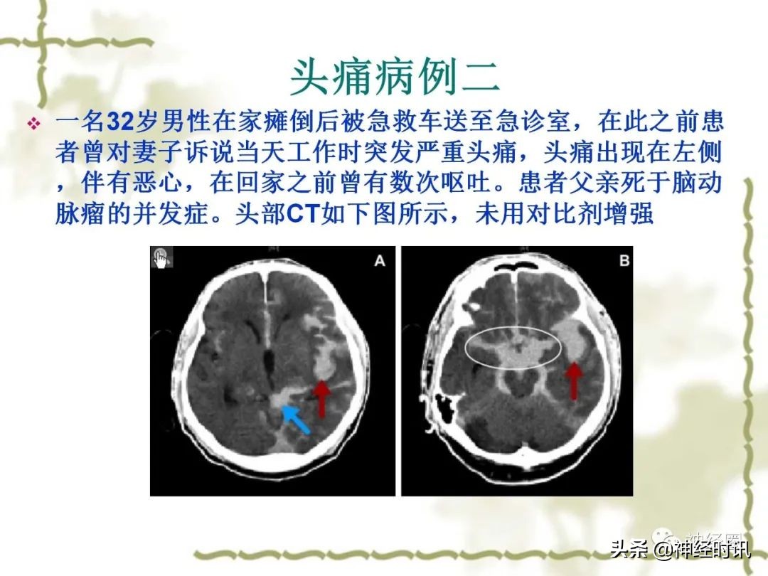 头痛从前额到头顶,头痛从左脑到右脑