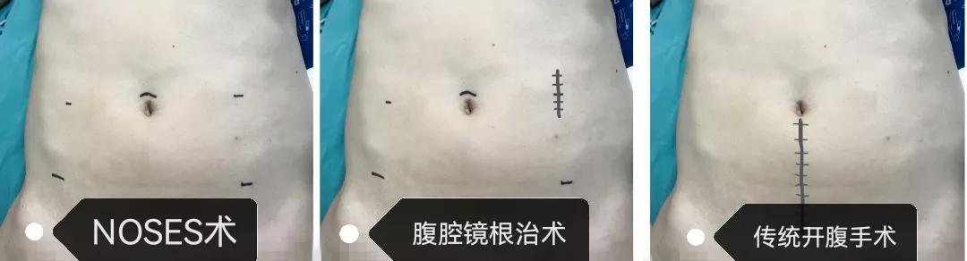 微创跟单孔腹腔镜的区别,微创腹腔镜单孔取胆结石