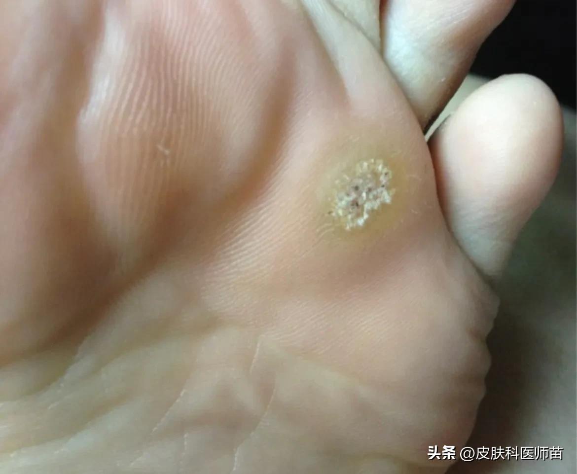 疣和痘痘怎么区分,自己如何鉴别疣