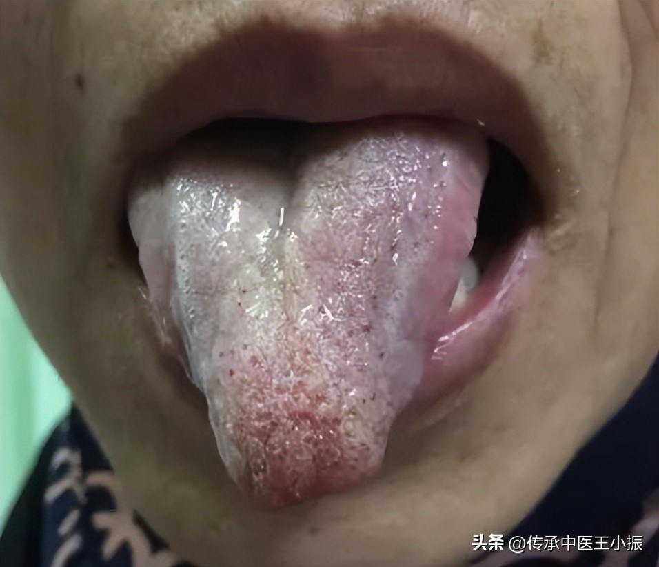 寒热舌诊图解大全,如何看舌象判断疾病准确用药