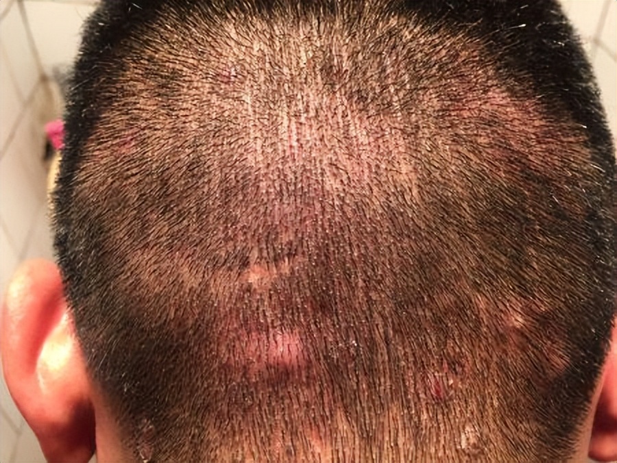 头皮总长小疙瘩和脓包怎么治疗,如何改善头皮长脓包和疙瘩的问题