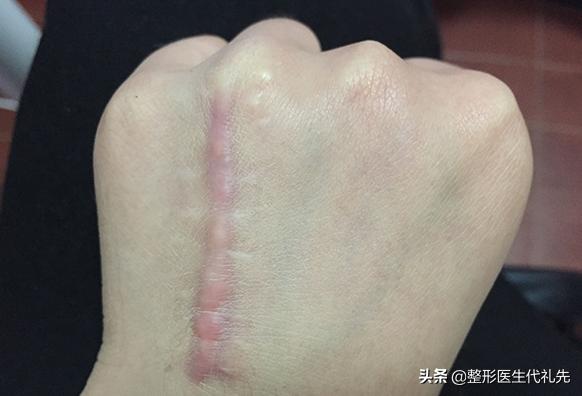 脂肪型眼袋伴有泪沟怎么办,眶隔脂肪释放去眼袋是怎么回事