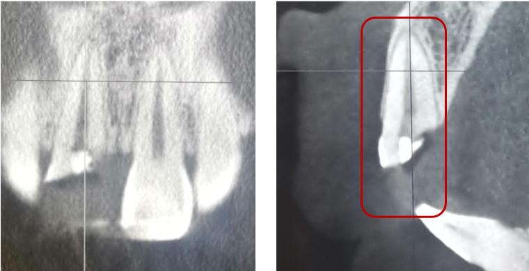 牙齿受外伤吃什么对牙好,牙齿受损伤引起牙痛怎么办
