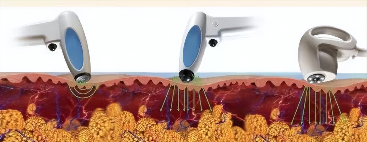 有效去黑眼圈和泪沟方法,黑眼圈泪沟抗衰老