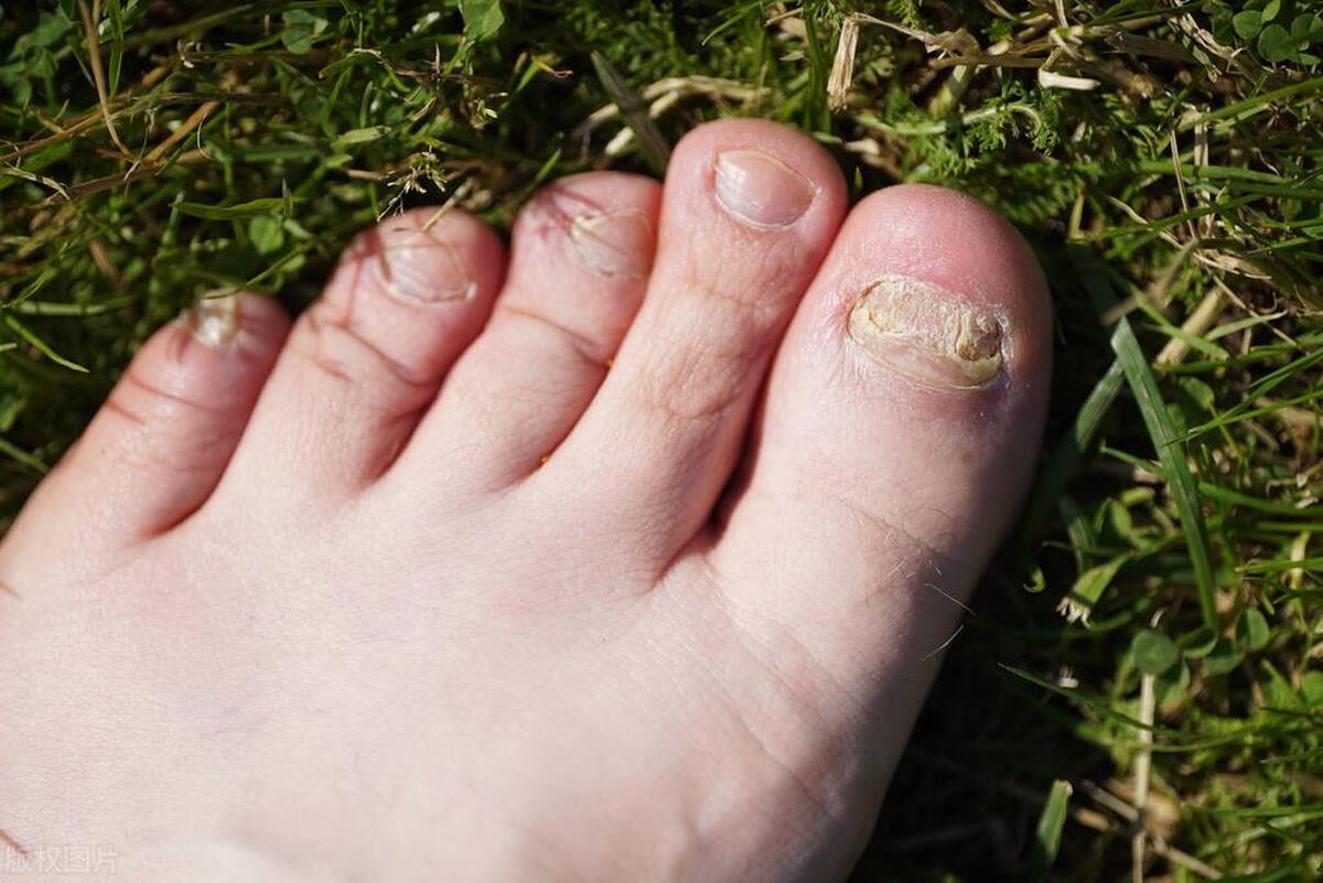 各种真菌感染的皮肤病看过来,真菌探秘