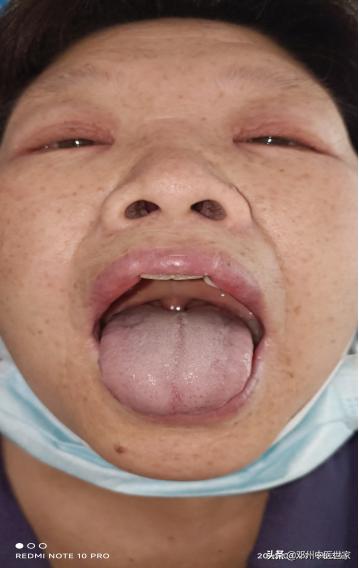 头面水肿的中医辨证论治,突发性水肿中医治疗