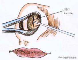 隆鼻后为什么没用夹板,隆鼻后鼻头感觉有点歪怎么办