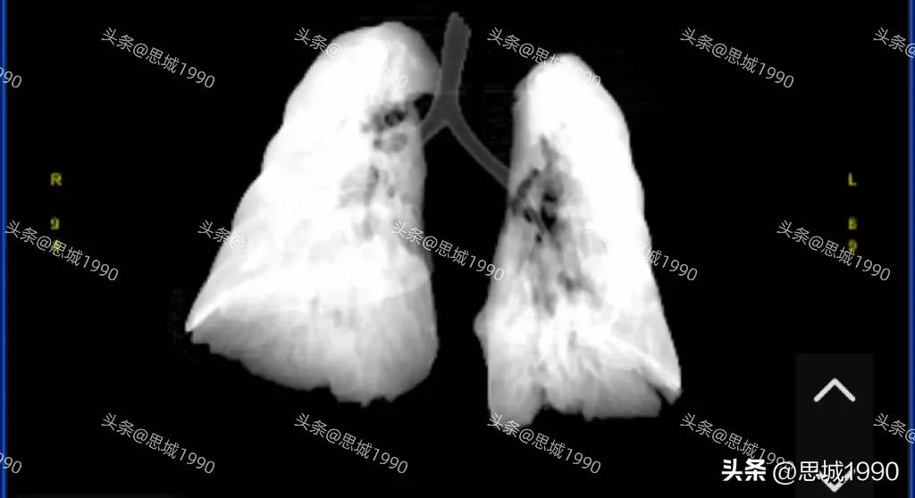 20天宝宝肺炎住院的话怎么治疗,50天婴儿肺炎好了两天又咳嗽