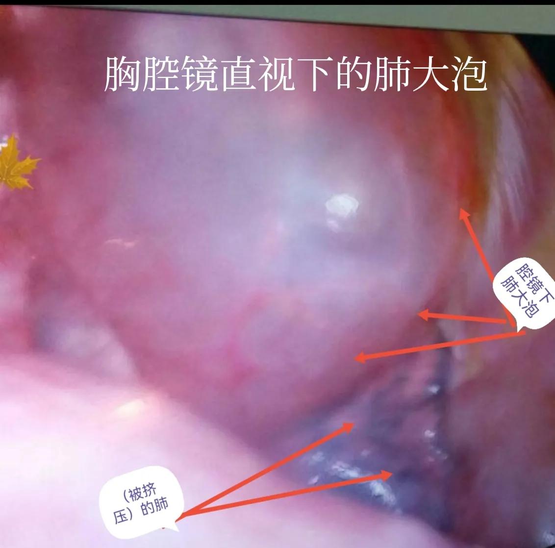 肺大泡产生的原因及治疗方案,肺大泡怎么治疗断根