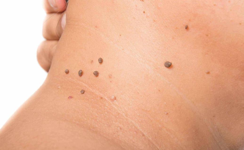 不论男女，身上长出这5种“瘊子”，或已感染HPV病毒！千万别轻视