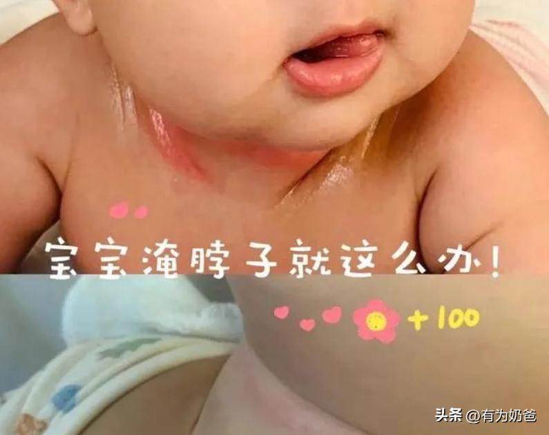 宝宝淹脖子红斑,宝宝淹脖子还起干皮