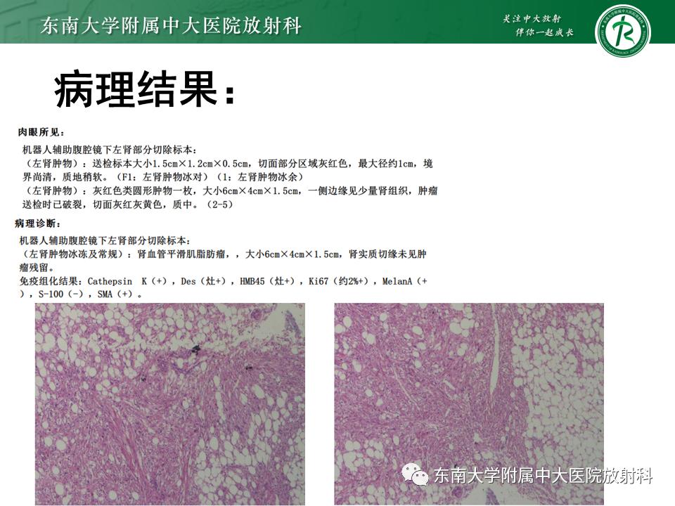 好文分享——《肾血管平滑肌脂肪瘤》