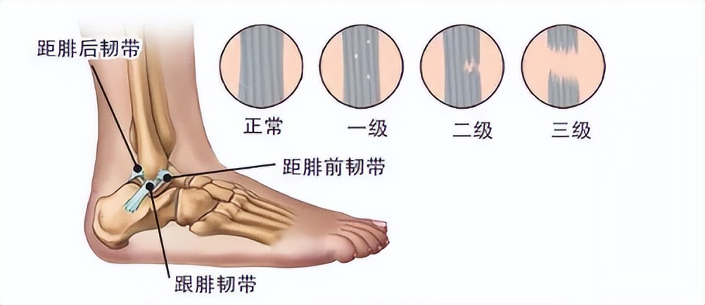 脚踝轻微扭伤如何处理,脚踝轻微扭伤用什么药物