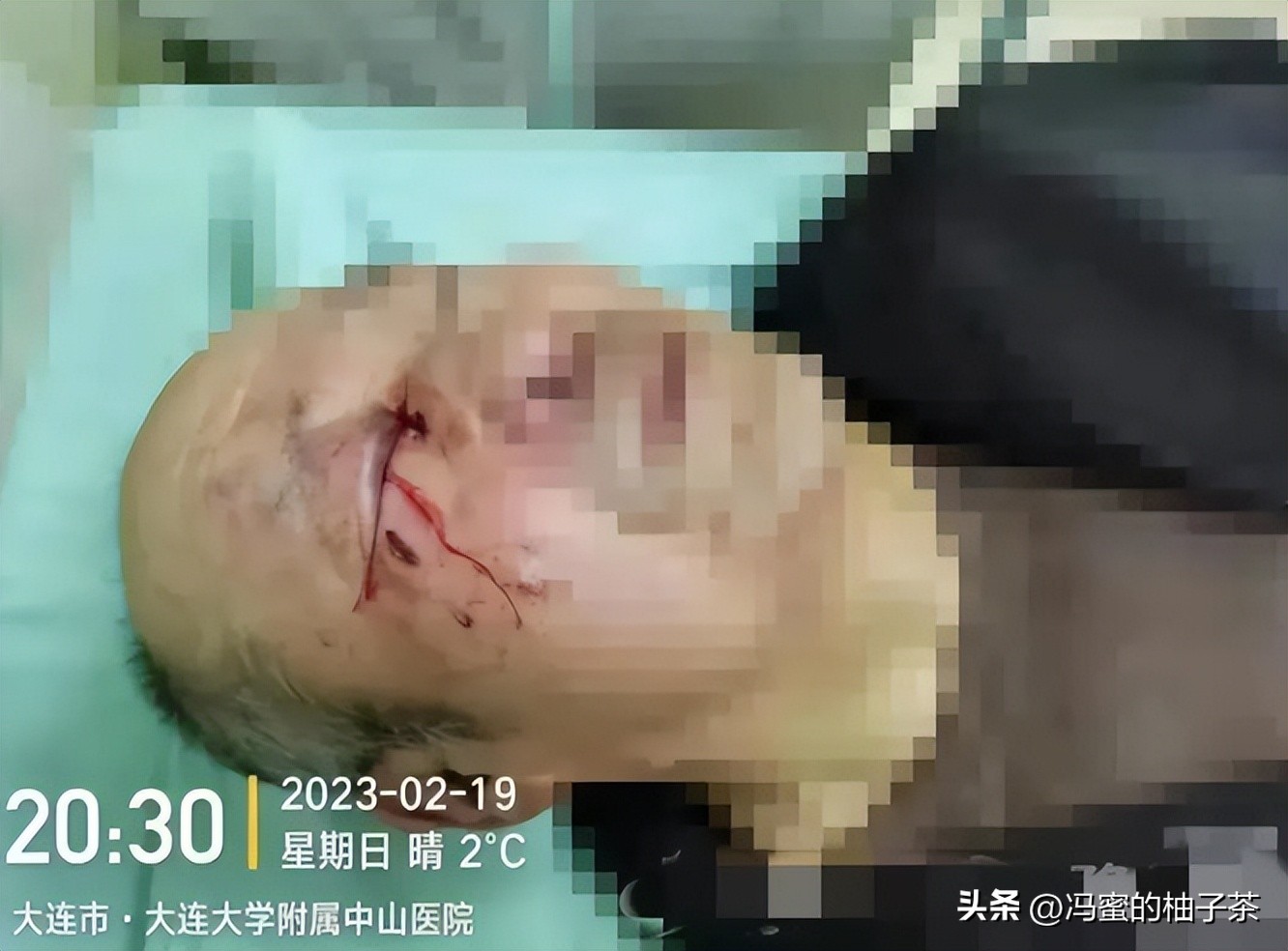 73岁老兵被护工打爆眼球第三集,73岁老人被护工打裂眼球后续