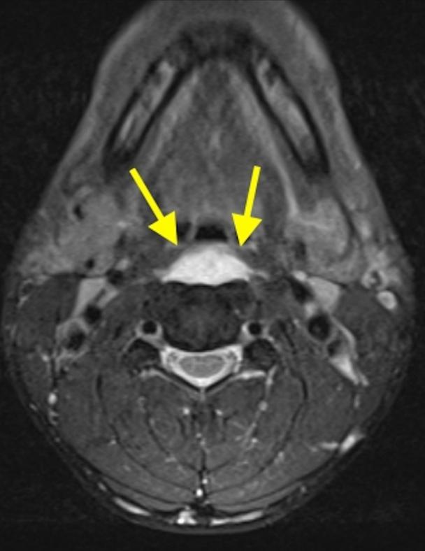 颈椎常见病变图片,颈椎严重的病例
