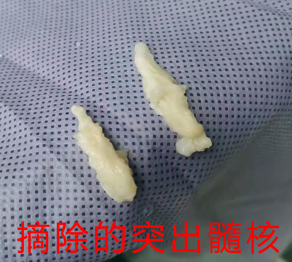 深圳市正康骨科医院腰椎间盘突出,深圳市腰椎间盘突出微创手术医院