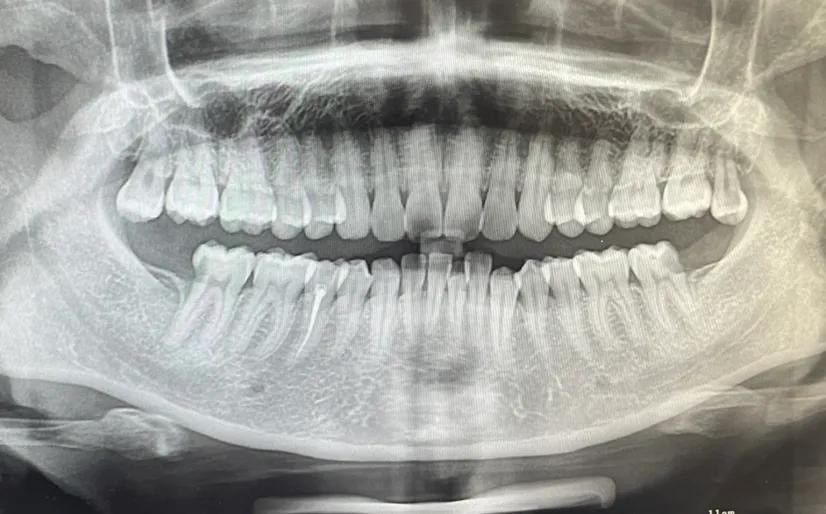 我种植牙两年牙冠掉了怎么办,种植牙即拔即种可行吗