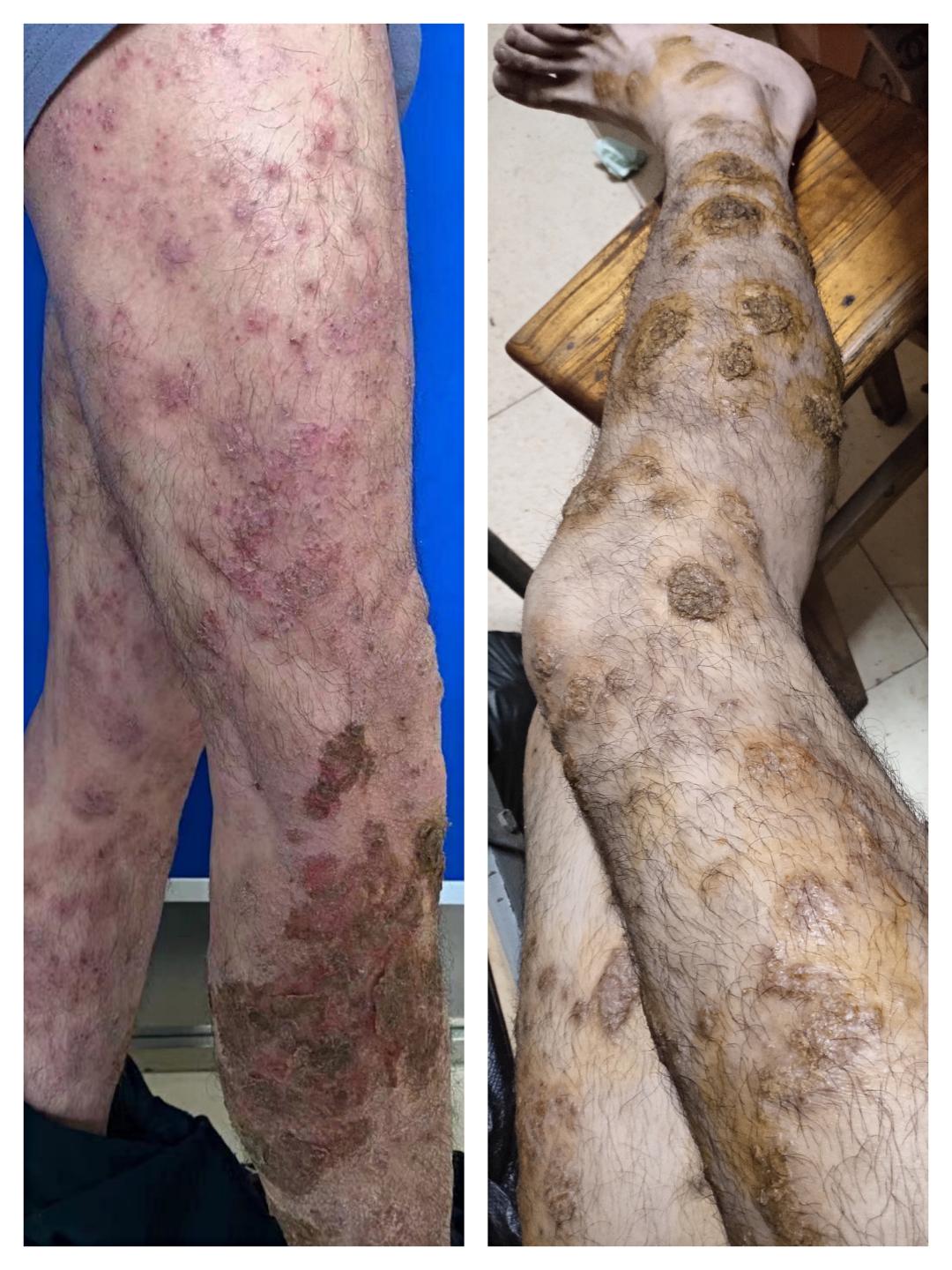 脸上长脓包脸肿了,脸上有个黄豆大小的脓包