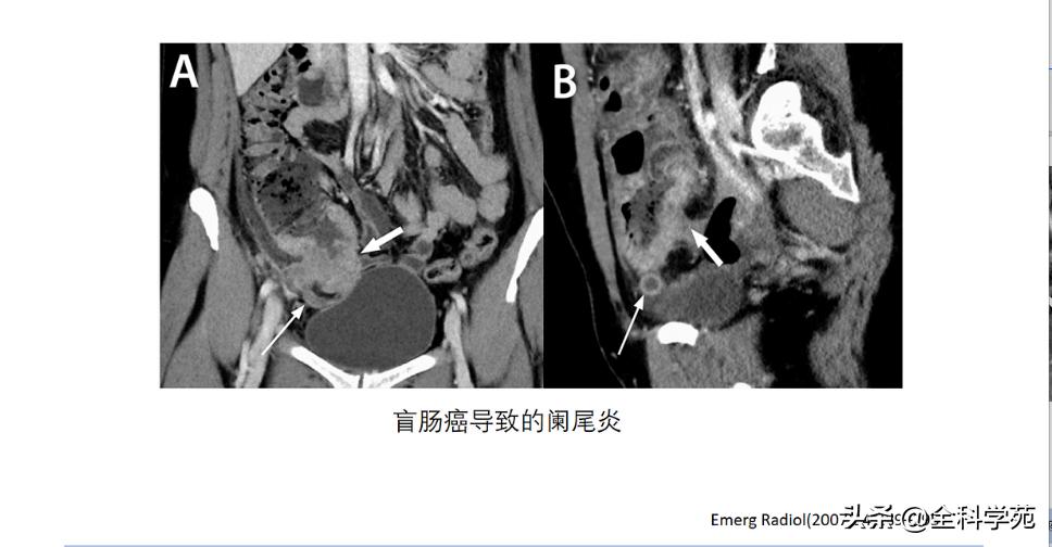 阑尾炎的讲解,关于阑尾炎的讨论总结