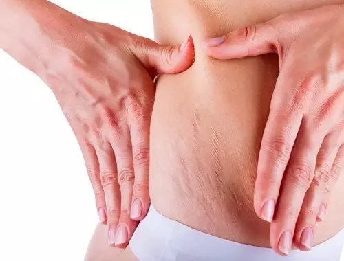 大腿上坑坑洼洼怎么办,大腿上坑坑洼洼的是什么原因