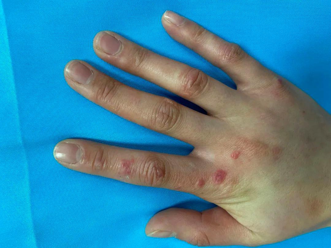 冻疮皮肤病的症状,冻疮容易得的皮肤病