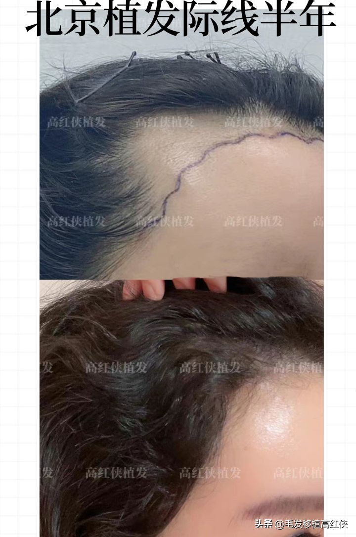 北京植发效果,植发半年后植发区感觉很紧绷